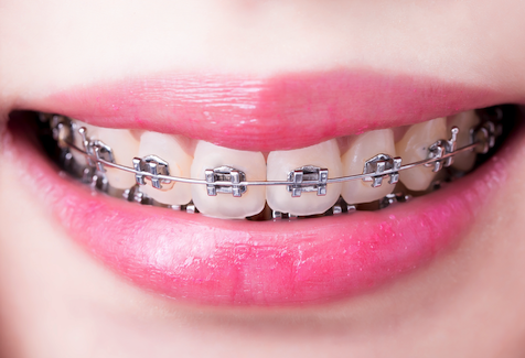 dental-braces-2